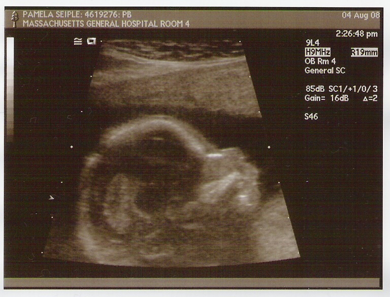 ultrasounds at 6 weeks. Lump#39;s headrain @ 17 weeks