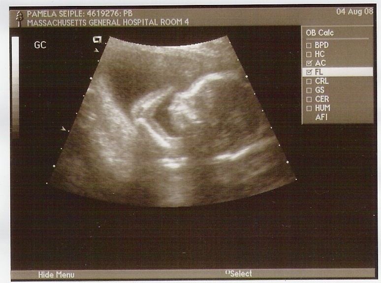 17 неделя часто. УЗИ 17 недель беременности. Фото УЗИ беременности 16-17 недель. УЗИ плода 17 недель беременности. Снимок УЗИ на 17 неделе беременности.